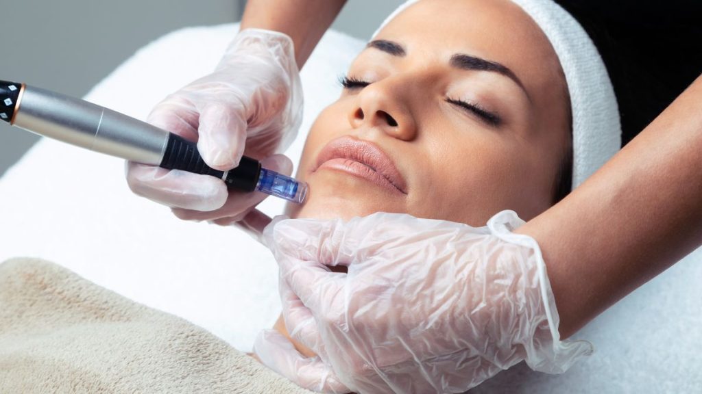 microneedling